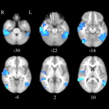 Screenshot photo of a brain scan. BioBasis for Autism