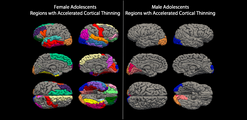 Image of female and male brain scans showing regions with accelerated cortical thinning.